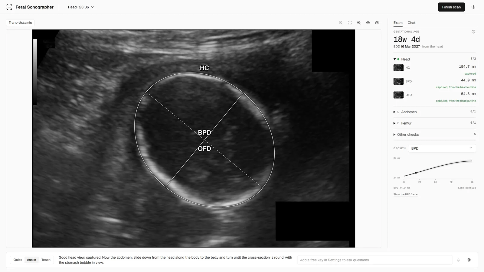 Fetal Sonographer showing an 18-week head scan, its measured outline and the exam panel.